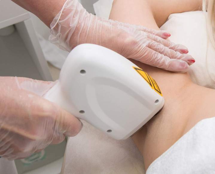 Faire une épilation par la technique du laser Colmar