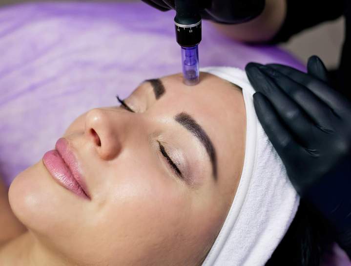 Microneedling Colmar